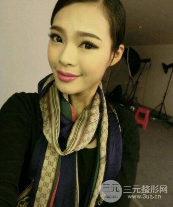 模特做隆鼻整形真實(shí)日記分享，附上恢復(fù)過程圖