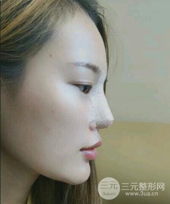 模特做隆鼻整形真實(shí)日記分享，附上恢復(fù)過程圖