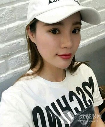 模特做隆鼻整形真實(shí)日記分享，附上恢復(fù)過程圖