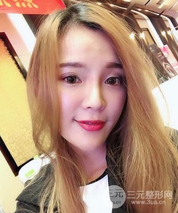 模特做隆鼻整形真實(shí)日記分享，附上恢復(fù)過程圖