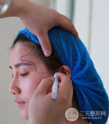 網(wǎng)絡主播做自體脂肪豐太陽穴真實案例分享，果杠杠的