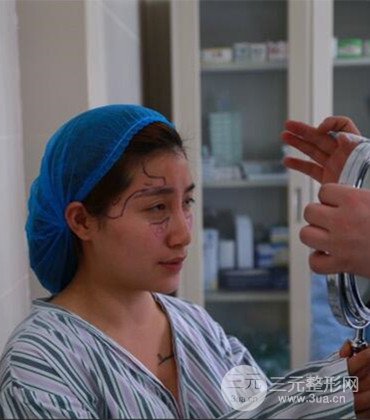 網(wǎng)絡主播做自體脂肪豐太陽穴真實案例分享，果杠杠的