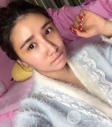 網(wǎng)絡主播做自體脂肪豐太陽穴真實案例分享，果杠杠的