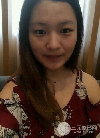 深圳雙眼皮正就內(nèi)雙小眼睛,真實(shí)案例前后對比照片