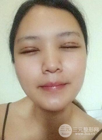 深圳雙眼皮正就內(nèi)雙小眼睛,真實(shí)案例前后對比照片