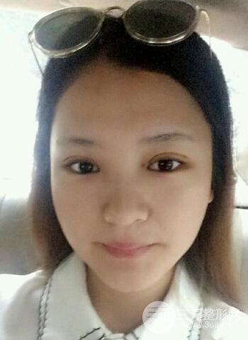 深圳雙眼皮正就內(nèi)雙小眼睛,真實(shí)案例前后對比照片