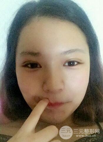 深圳雙眼皮正就內(nèi)雙小眼睛,真實(shí)案例前后對比照片