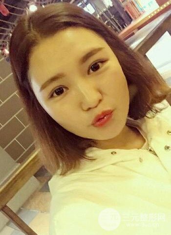 深圳雙眼皮正就內(nèi)雙小眼睛,真實(shí)案例前后對比照片