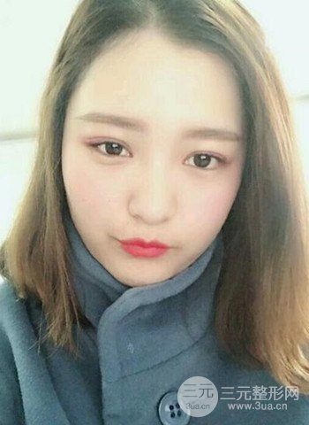 深圳雙眼皮正就內(nèi)雙小眼睛,真實(shí)案例前后對比照片