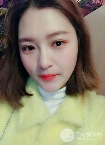 深圳雙眼皮正就內(nèi)雙小眼睛,真實(shí)案例前后對比照片