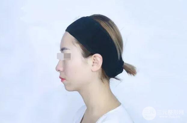 瑞蘭隆鼻多少錢 瑞蘭隆鼻真實(shí)一個(gè)月恢復(fù)前后對(duì)比圖案例