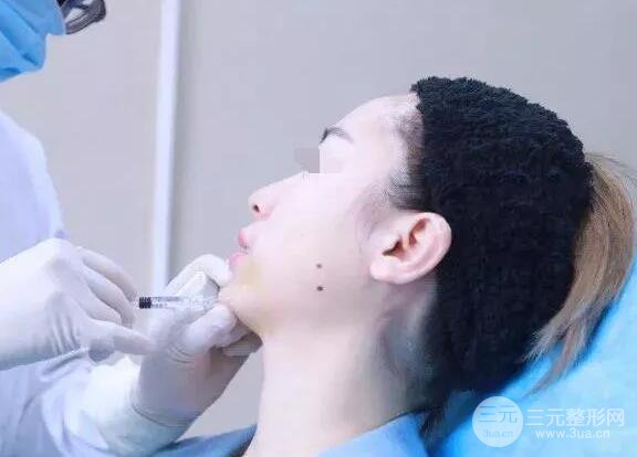 瑞蘭隆鼻多少錢 瑞蘭隆鼻真實(shí)一個(gè)月恢復(fù)前后對(duì)比圖案例