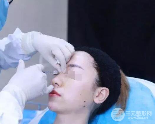 瑞蘭隆鼻多少錢 瑞蘭隆鼻真實(shí)一個(gè)月恢復(fù)前后對(duì)比圖案例