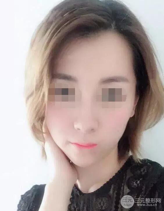 瑞蘭隆鼻多少錢 瑞蘭隆鼻真實(shí)一個(gè)月恢復(fù)前后對(duì)比圖案例