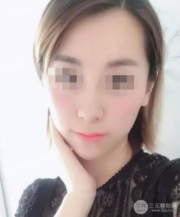 瑞蘭隆鼻多少錢 瑞蘭隆鼻真實(shí)一個(gè)月恢復(fù)前后對(duì)比圖案例