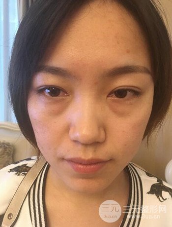 北京內(nèi)切祛眼袋真人案例果對比分享，年輕十歲不是夢