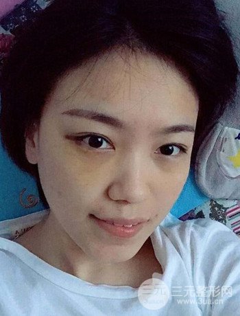 北京內(nèi)切祛眼袋真人案例果對比分享，年輕十歲不是夢