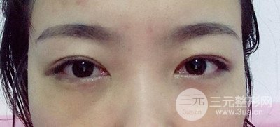 北京內(nèi)切祛眼袋真人案例果對比分享，年輕十歲不是夢