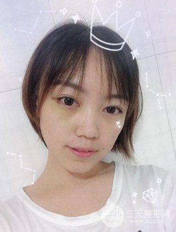 北京內(nèi)切祛眼袋真人案例果對比分享，年輕十歲不是夢