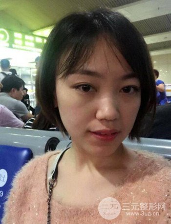 北京內(nèi)切祛眼袋真人案例果對比分享，年輕十歲不是夢