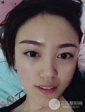 北京內(nèi)切祛眼袋真人案例果對比分享，年輕十歲不是夢