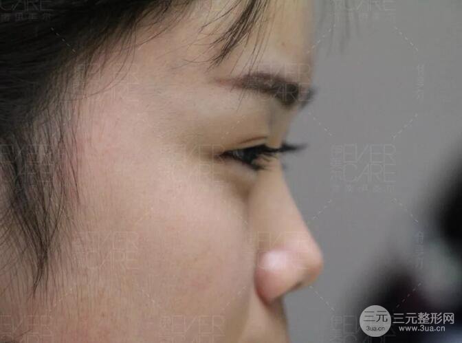 北京伊美爾徐軍假體隆鼻前后對(duì)比照片心情日記