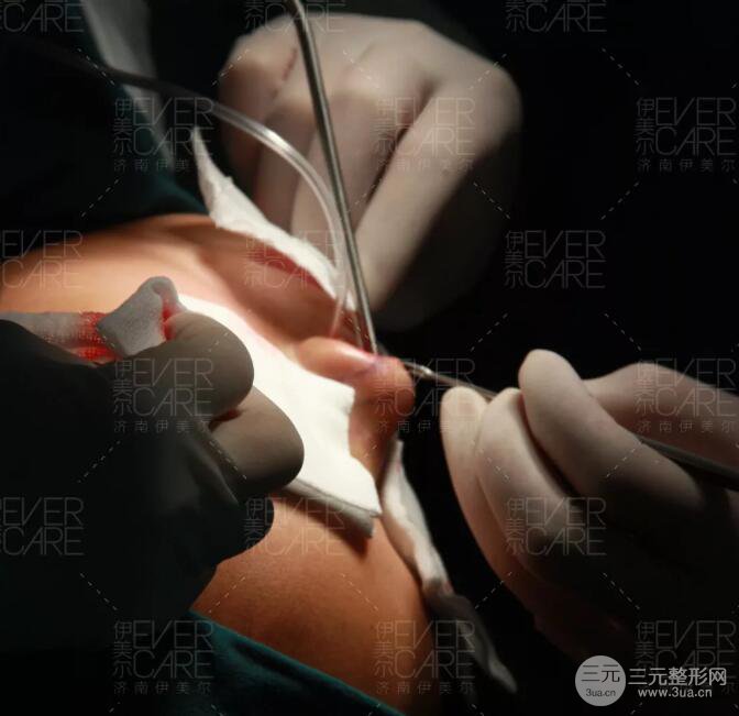 北京伊美爾徐軍假體隆鼻前后對(duì)比照片心情日記