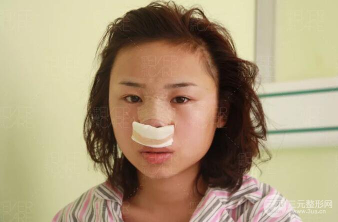 北京伊美爾徐軍假體隆鼻前后對(duì)比照片心情日記