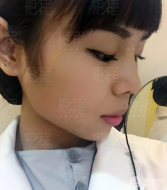 北京伊美爾徐軍假體隆鼻前后對(duì)比照片心情日記