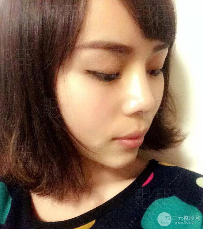 北京伊美爾徐軍假體隆鼻前后對(duì)比照片心情日記