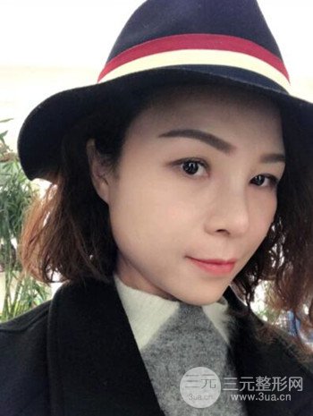 隆鼻整形手術真人案例恢復過程分享 附上果圖