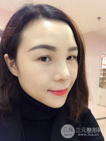 隆鼻整形手術真人案例恢復過程分享 附上果圖