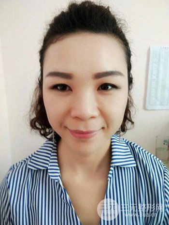 隆鼻整形手術真人案例恢復過程分享 附上果圖