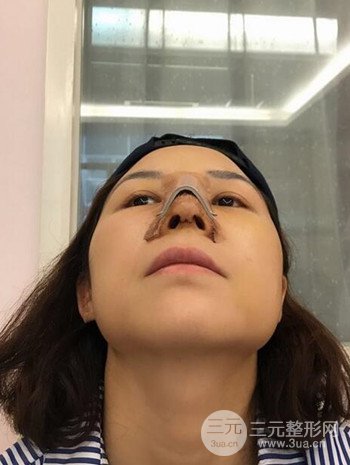 隆鼻整形手術真人案例恢復過程分享 附上果圖