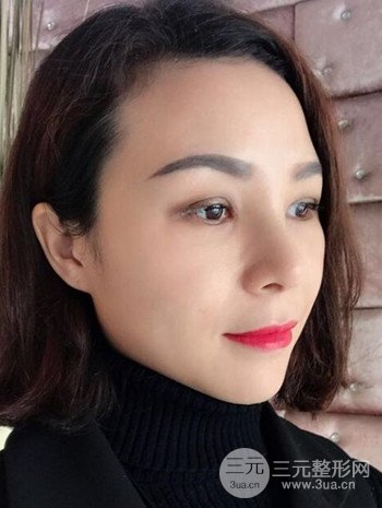 隆鼻整形手術真人案例恢復過程分享 附上果圖