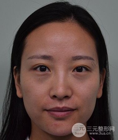 內(nèi)切微創(chuàng)去眼袋手術案例分享，附上手術恢復照片