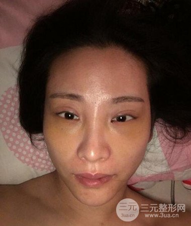 內(nèi)切微創(chuàng)去眼袋手術案例分享，附上手術恢復照片