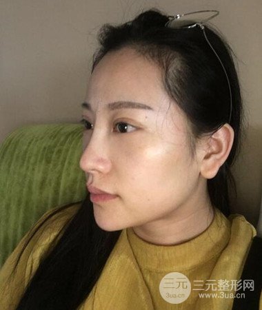 內(nèi)切微創(chuàng)去眼袋手術案例分享，附上手術恢復照片