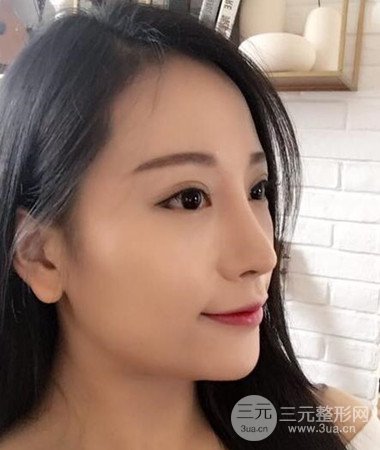 內(nèi)切微創(chuàng)去眼袋手術案例分享，附上手術恢復照片