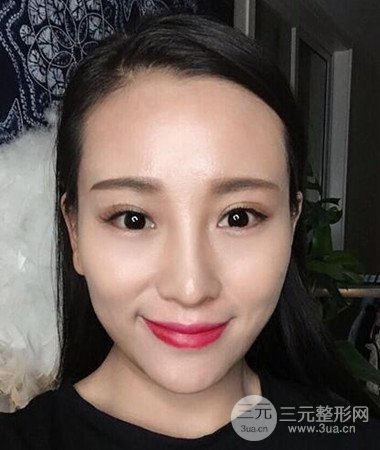 內(nèi)切微創(chuàng)去眼袋手術案例分享，附上手術恢復照片