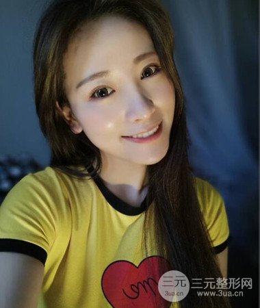 內(nèi)切微創(chuàng)去眼袋手術案例分享，附上手術恢復照片