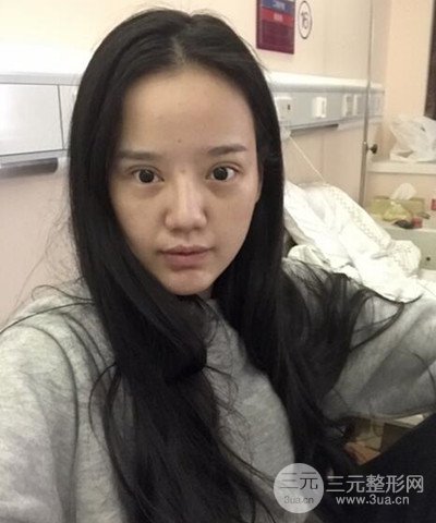 做了隆鼻整形成功落實(shí)精致小巧鼻 附上果圖