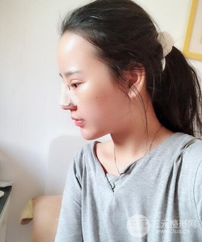 做了隆鼻整形成功落實(shí)精致小巧鼻 附上果圖