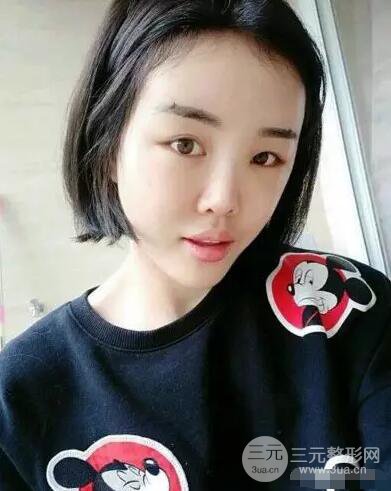 成都玉之光自體脂肪面部填充劉中國真人案例反饋|內(nèi)附對(duì)比前后照