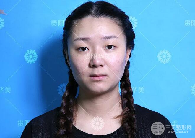 貴陽(yáng)華美郭宗科全切雙眼皮+假體隆鼻案例前后對(duì)比圖 華美員工全臉整形實(shí)錄