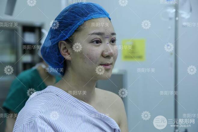 貴陽(yáng)華美郭宗科全切雙眼皮+假體隆鼻案例前后對(duì)比圖 華美員工全臉整形實(shí)錄