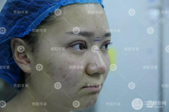 貴陽(yáng)華美郭宗科全切雙眼皮+假體隆鼻案例前后對(duì)比圖 華美員工全臉整形實(shí)錄