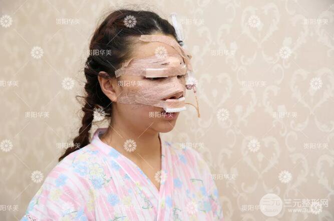 貴陽(yáng)華美郭宗科全切雙眼皮+假體隆鼻案例前后對(duì)比圖 華美員工全臉整形實(shí)錄