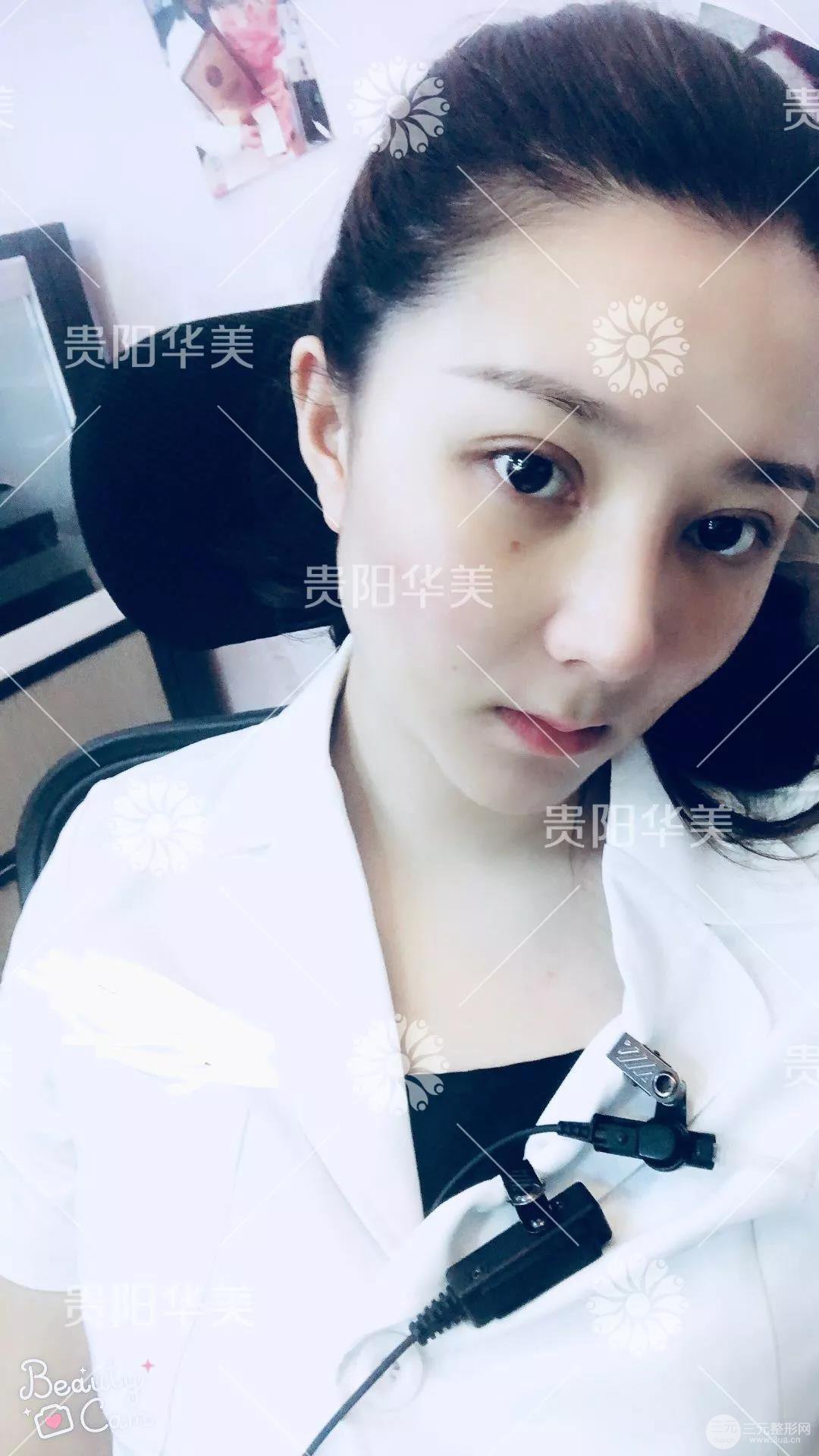 貴陽(yáng)華美郭宗科全切雙眼皮+假體隆鼻案例前后對(duì)比圖 華美員工全臉整形實(shí)錄