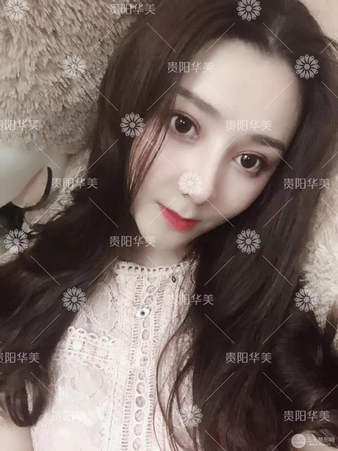 貴陽(yáng)華美郭宗科全切雙眼皮+假體隆鼻案例前后對(duì)比圖 華美員工全臉整形實(shí)錄